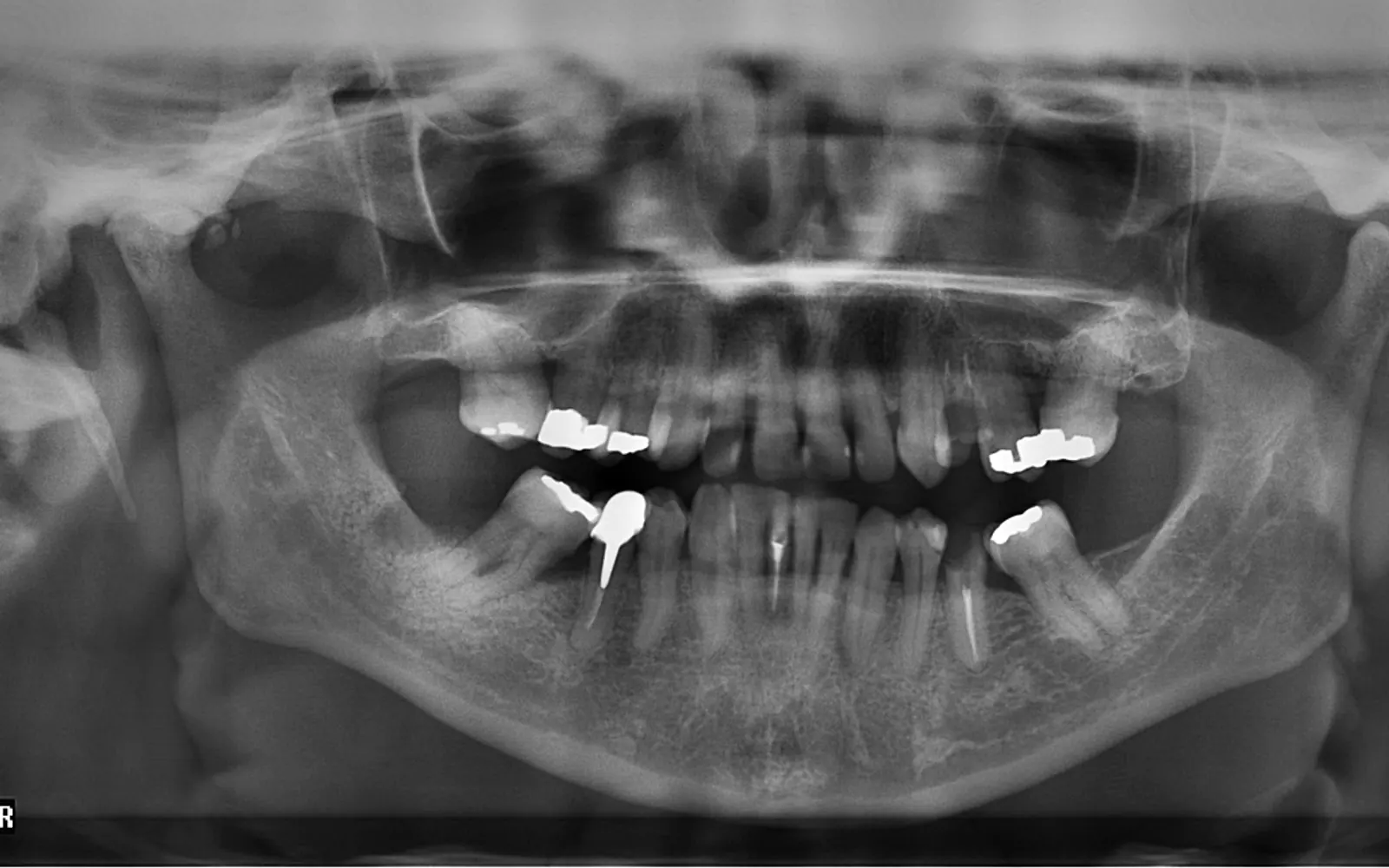 X-ray, teeth and lightning